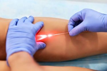 Laser endoveineux
