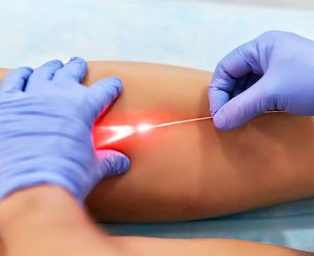 Laser endoveineux